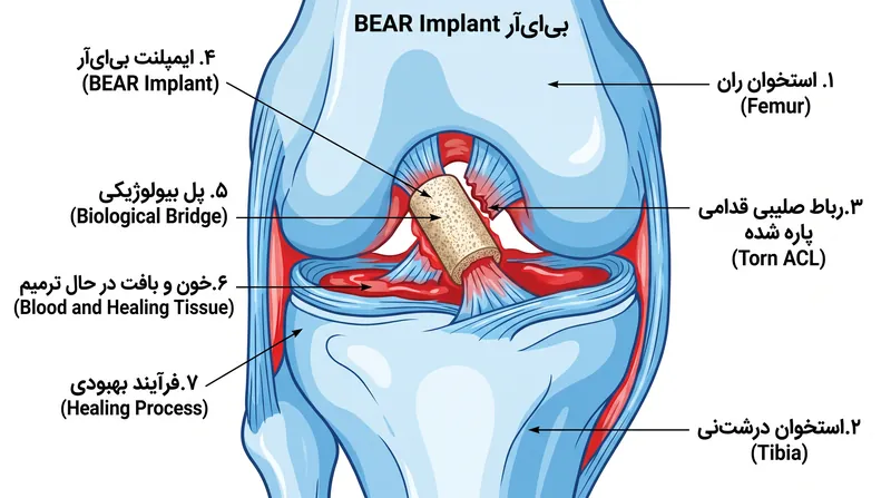 برخلاف پیوندهای سنتی، ایمپلنت بِیاِیآر (BEAR) مانند یک پل بیولوژیکی عمل میکند که به رباط اجازه میدهد خودش را ترمیم کند.