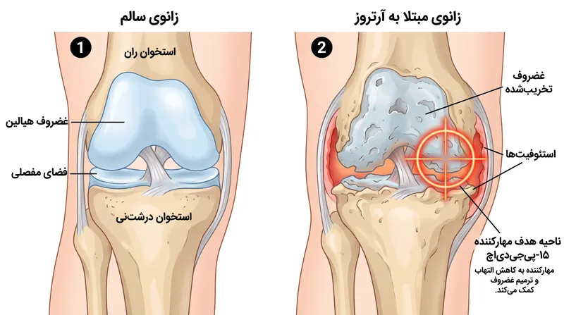 مهارکننده ۱۵-پیجیدیاچ ماتریکس غضروفی تخریبشده را هدف قرار میدهد و سلولهای موجود را وادار به بازسازی بالشتک طبیعی مفصل میکند.