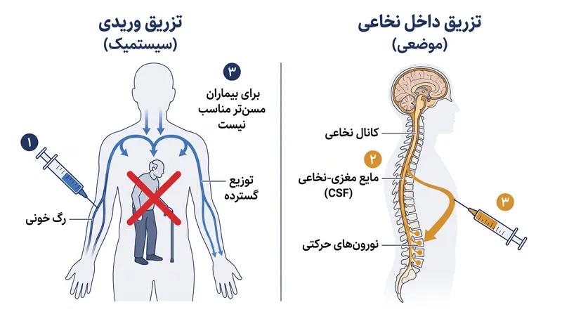 تزریق داخل نخاعی سد خونی-مغزی را دور میزند و به ژندرمانی اجازه میدهد که بدون نیاز به بار ویروسی عظیم و سیستمیک، به نورونهای حرکتی برسد.