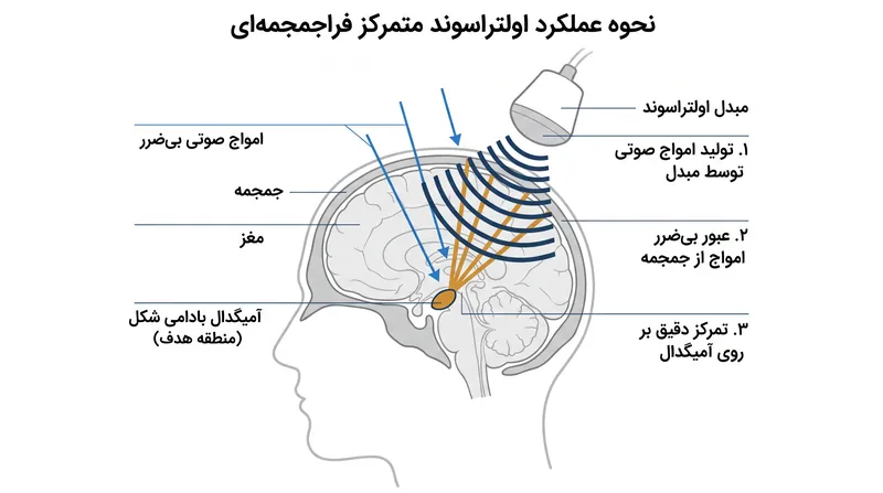 امواج صوتی به طور بی‌ضرر از قشر مغز عبور کرده و در آمیگدال متمرکز می‌شوند و فعالیت الکتریکی نورون‌های هدف‌گذاری شده را تغییر می‌دهند.