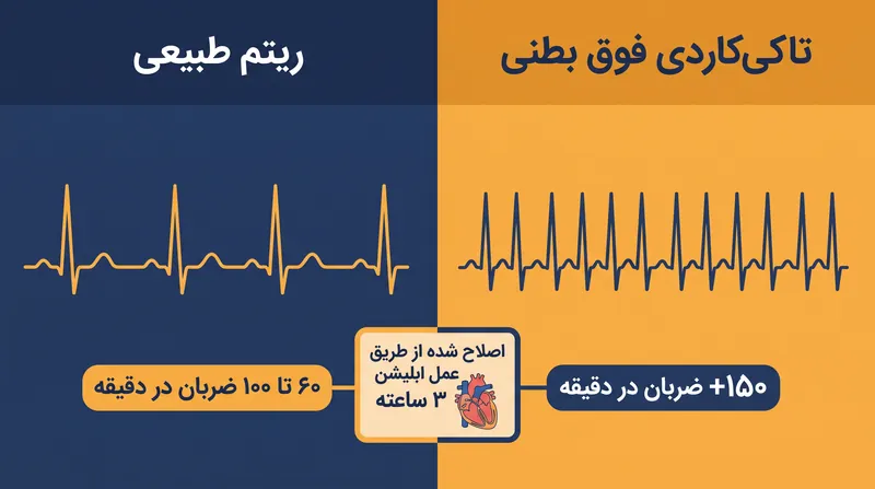 تاکی‌کاردی فوق بطنی (SVT) باعث ضربان قلب ناگهانی و خطرناکاً سریع می‌شود، که اکنون می‌توان آن را با ابلیشن (سوزاندن) کم تهاجمی اصلاح کرد.