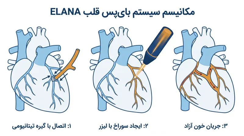 تکنیک آناستوموز بدون بخیه از یک گیره تیتانیومی و یک لیزر اگزایمر برای اتصال عروق بدون قطع جریان خون استفاده میکند.
