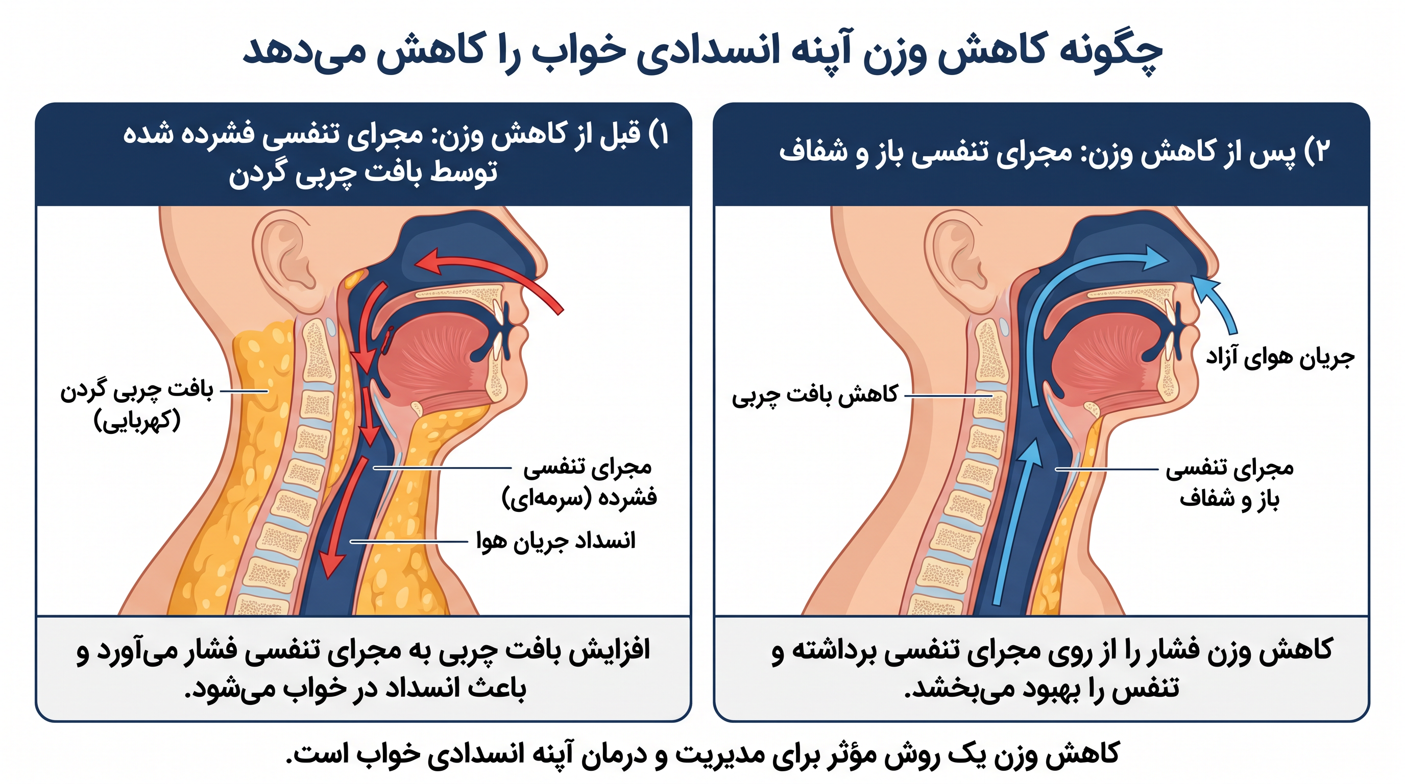 زپباند با کاهش بافت چربی در گردن و مجرای تنفسی فوقانی، فشار ساختاری ایجادکننده اختلالات تنفسی را به صورت فیزیکی برطرف میکند.