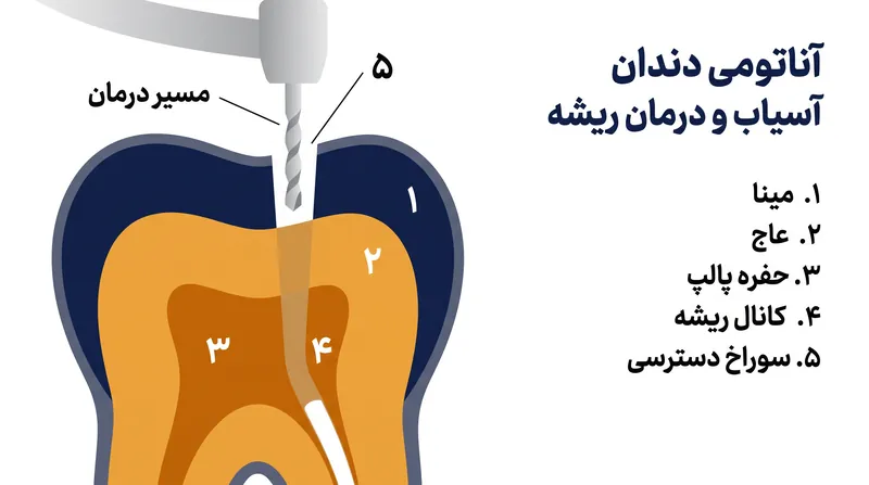 با سوراخ کردن عاج سخت و رسیدن به حفره پالپ، فشار ناشی از عفونت می‌توانست آزاد شود.