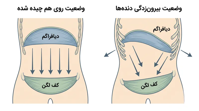 قفسه سینه بیرون‌زده (rib flare) دیافراگم و کف لگن را ناهماهنگ می‌کند و فشار را به جای تثبیت ستون فقرات، به سمت بیرون هدایت می‌کند.