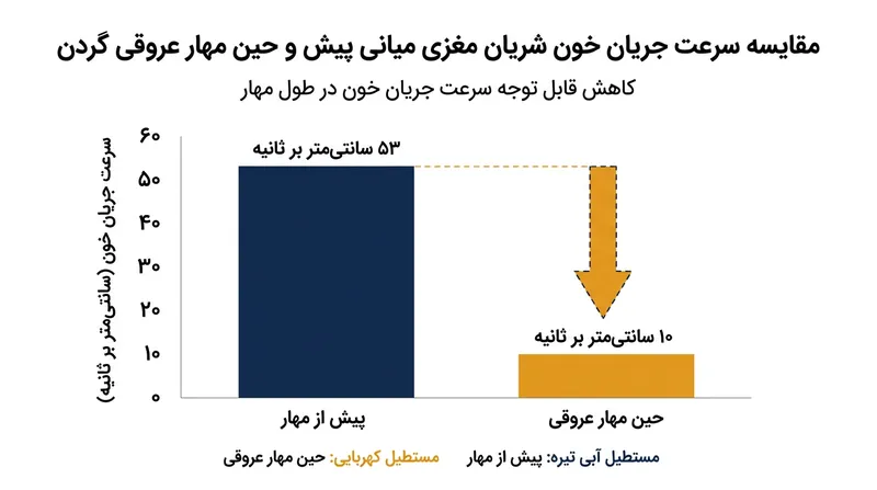 کاهش بیش از ۸۰ درصدی سرعت جریان خون در شریان مغزی میانی حین اجرای صحیح مهار عروقی گردن.
