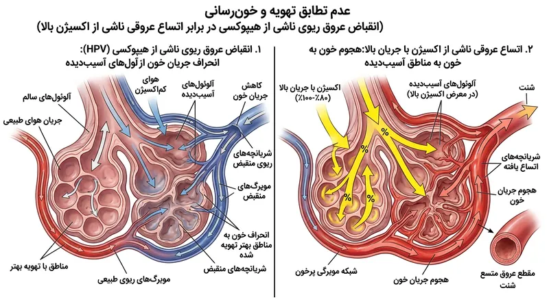 اکسیژن با دوز بالا، انقباض عروقی محافظتی ریه را معکوس می‌کند و خون را به نواحی آسیب‌دیده‌ای می‌فرستد که امکان دفع دی‌اکسید کربن را ندارند.