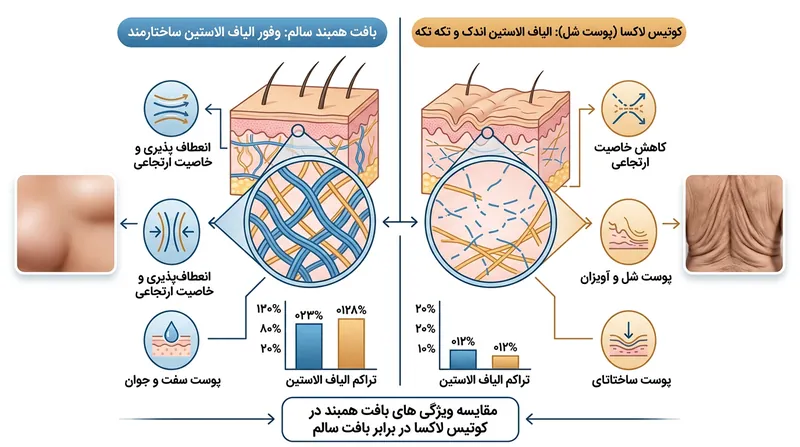 تفاوت ساختار الاستین در بافت همبند سالم و بافت مبتلا به کوتیس لاکسا.