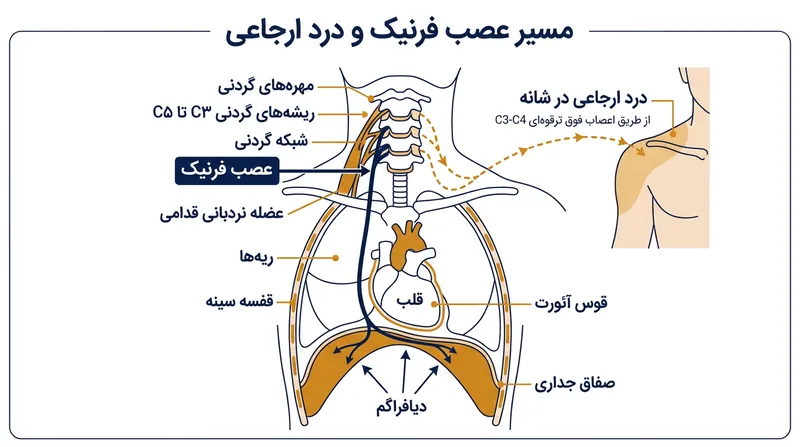 عصب فرنیک با اتصال صفاق جداری به مهره‌های گردنی، موجب بروز درد ارجاعی در نوک شانه می‌شود.