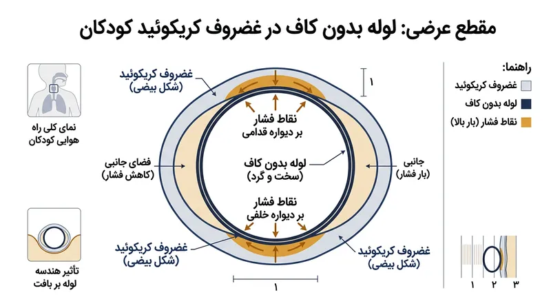 فرو بردن یک لوله گرد و صلب در راه هوایی بیضی‌شکل، فشار مخرب را بر دیواره‌های قدامی و خلفی متمرکز می‌کند.