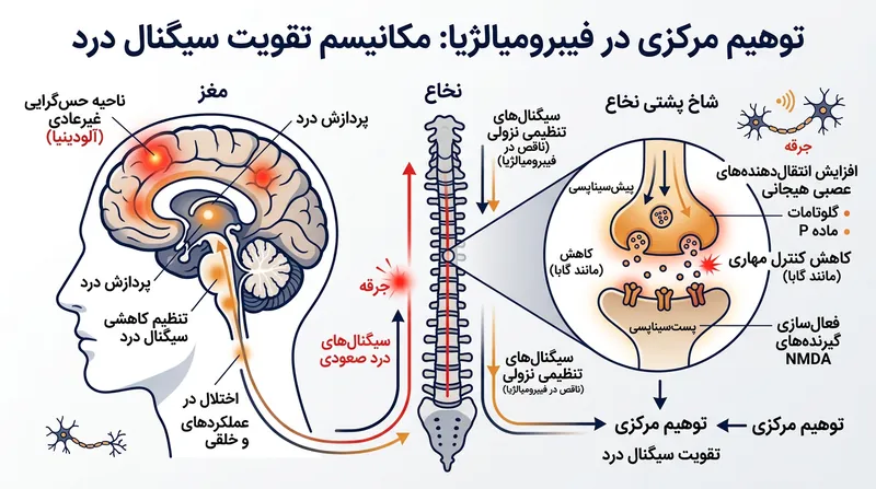 حساس‌شدگی مرکزی باعث می‌شود سیستم عصبی سیگنال‌های درد را به شکلی اغراق‌آمیز پردازش کند.