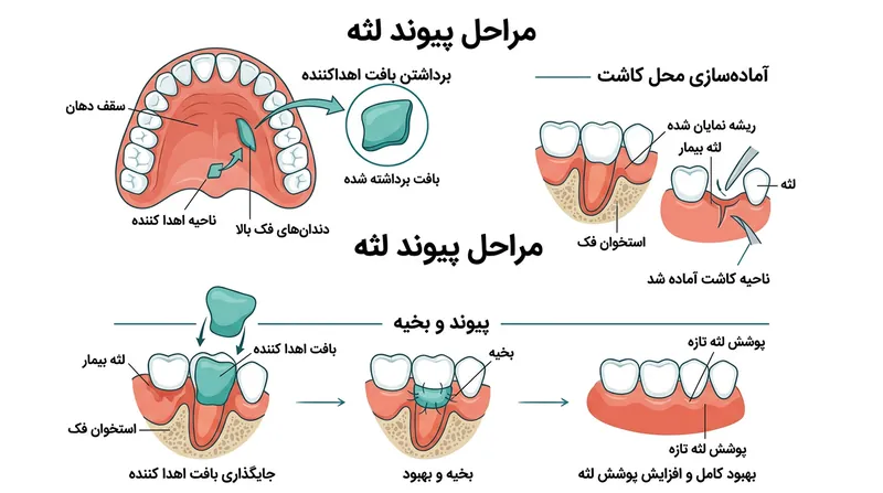 مراحل انجام جراحی پیوند بافت همبند برای پوشش مجدد ریشه دندان.