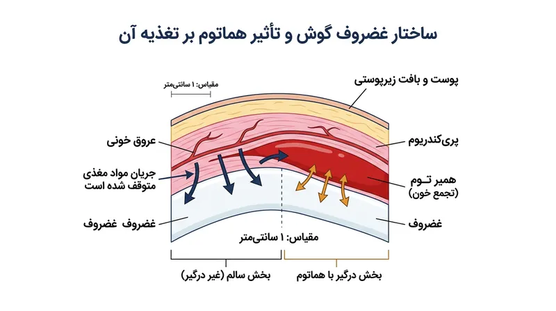 هماتوم زیر‌پری‌کندریوم با ایجاد مانعی فیزیکی، غضروف فاقد رگ را از دریافت اکسیژن محروم می‌کند.