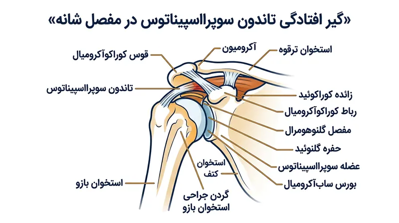 چرخش داخلی بازو حین بالا رفتن دست، تاندون سوپرااسپیناتوس را به‌طور مستقیم به سقف استخوانی شانه می‌کوبد.