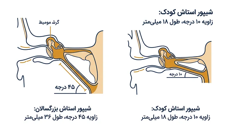شیپور استاش در کودکان نصف طول مجرای بزرگسالان بوده و بسیار افقی‌تر است، در نتیجه مزیت جاذبه برای تخلیه ترشحات عملاً وجود ندارد.