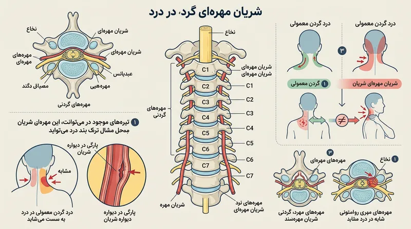شریان مهره‌ای در گردن؛ پارگی‌های پیش‌موجود در این عروق می‌توانند علائمی شبیه به گرفتگی عضلانی ایجاد کنند.