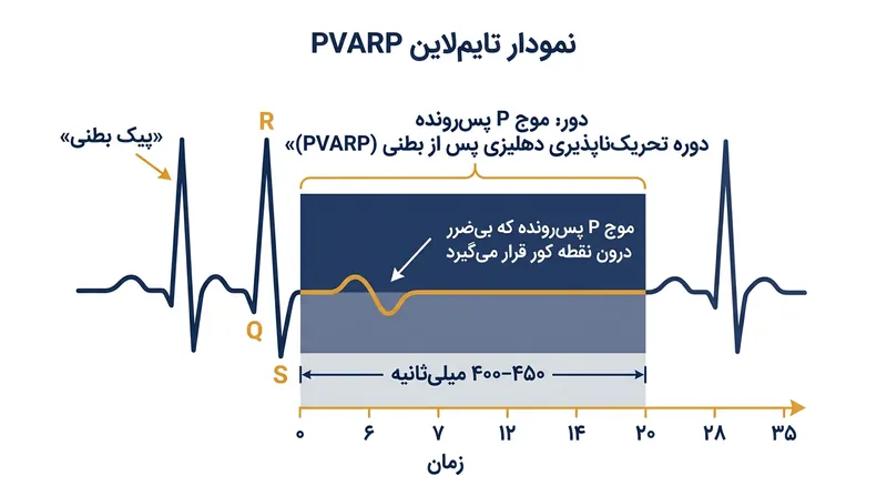 تمدید نقطه کورِ پس از بطن در ضربان‌ساز مانع از دیدن و ردیابی پژواک‌های پس‌رونده می‌شود.
