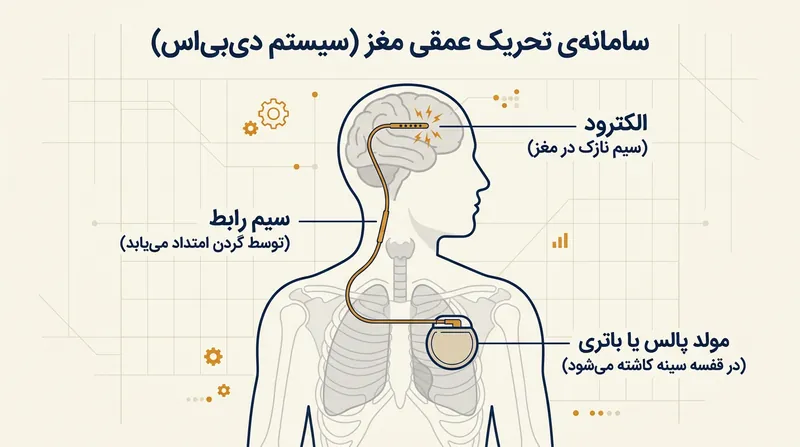 نحوه اتصال الکترودهای مغزی به مولد پالس از طریق سیم‌های رابط زیرپوستی.