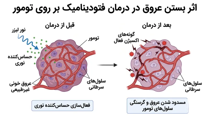 درمان فتودینامیک با تخریب رگ‌های خونی تغذیه‌کننده، تومور را از اکسیژن و مواد مغذی محروم می‌کند.