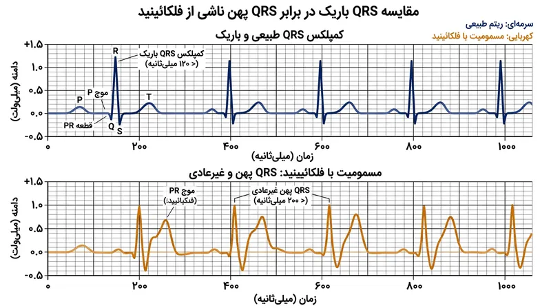 مهار گسترده کانال‌های سدیم سرعت هدایت بطنی را کند کرده و به‌صورت پهن شدن کمپلکس QRS آشکار می‌شود.