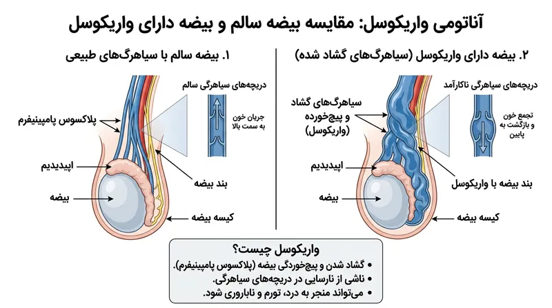 واریکوسل زمانی رخ می‌دهد که دریچه‌های وریدی از کار می‌افتند و خون در اطراف بیضه تجمع می‌یابد.