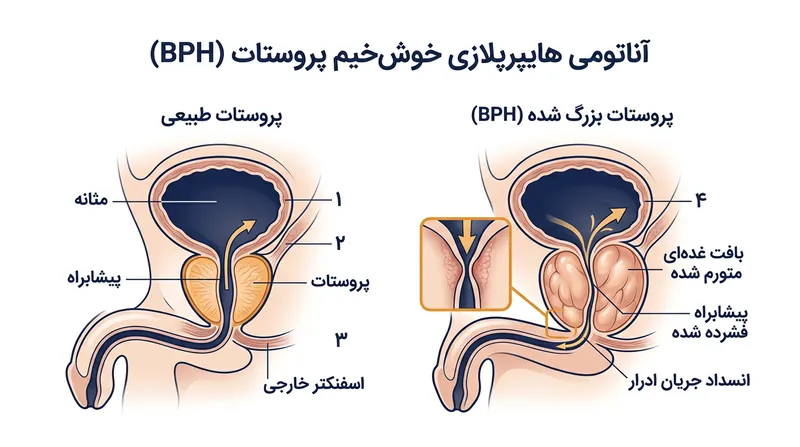 رشد بافت پروستات در ناحیه انتقال باعث فشرده شدن مجرای ادرار و بروز علائم تخلیه‌ای می‌شود.