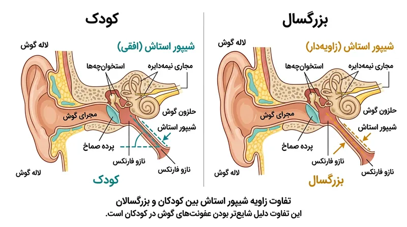 زاویه افقی شیپور استاش در کودکان، تخلیه مایعات را دشوارتر کرده و خطر عفونت را افزایش می‌دهد.