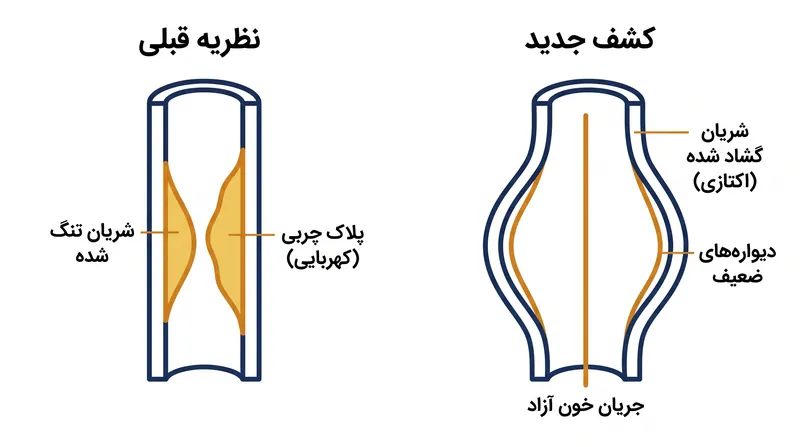 این مطالعه نشان داد که گشاد شدن شریان (اکتازی)، به جای تجمع پلاک، نقص ساختاری پشت سکته‌های لاکونار است.