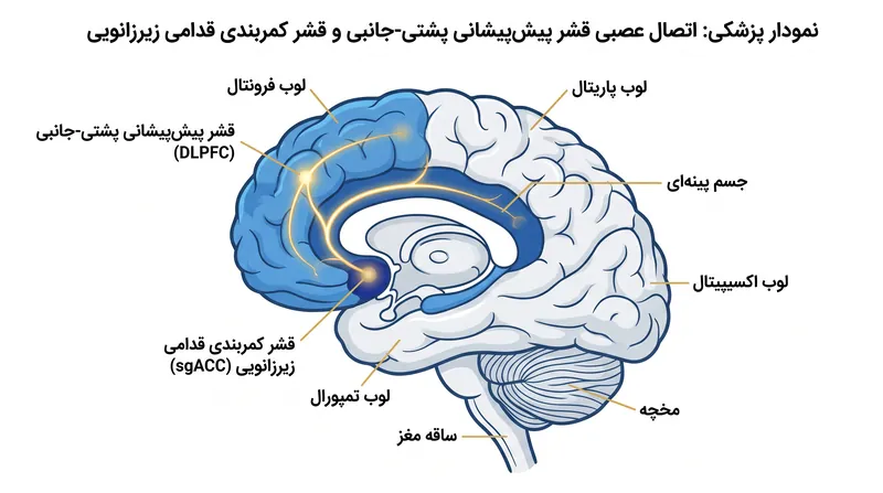 سازوکار عمل: این دستگاه قشر پیش‌پیشانی پشتی-جانبی در سطح مغز را هدف قرار می‌دهد، که به عنوان یک سوئیچ رله عصبی عمل می‌کند تا قشر کمربندی قدامی زیرزانویی بیش‌فعال در عمق مغز را آرام کند.