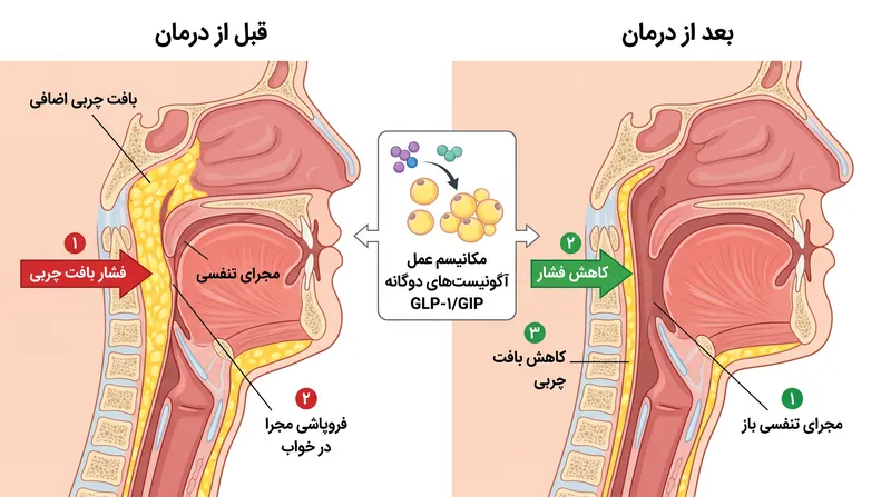 این دارو با ایجاد کاهش وزن قابل توجه، توده بافت فیزیکی را که عامل فروپاشی مجرای تنفسی است، کاهش می‌دهد.