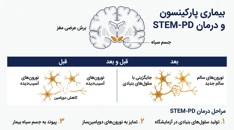 نحوه جایگزینی نورون‌های تولیدکننده دوپامین از دست رفته در مغز توسط درمان STEM-PD.