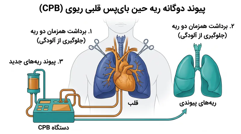 برداشتن همزمان هر دو ریه در حین بای‌پس قلبی ریوی، از کاشت سلول‌های سرطانی در اندام‌های اهداکننده جدید جلوگیری می‌کند.