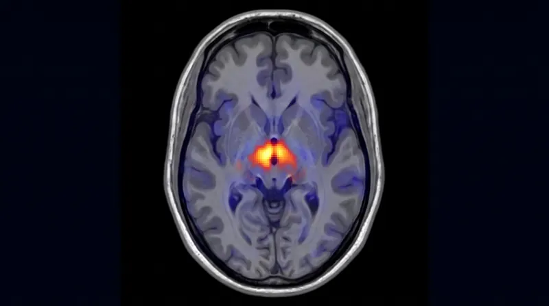 اسکن‌های fMRI نشان می‌دهند که طب سوزنی، مراکز اصلی کنترل درد در مغز را تنظیم می‌کند.